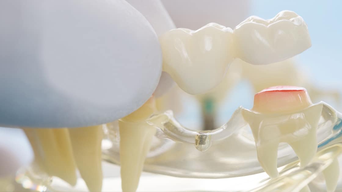 Dental Bridge Model photo