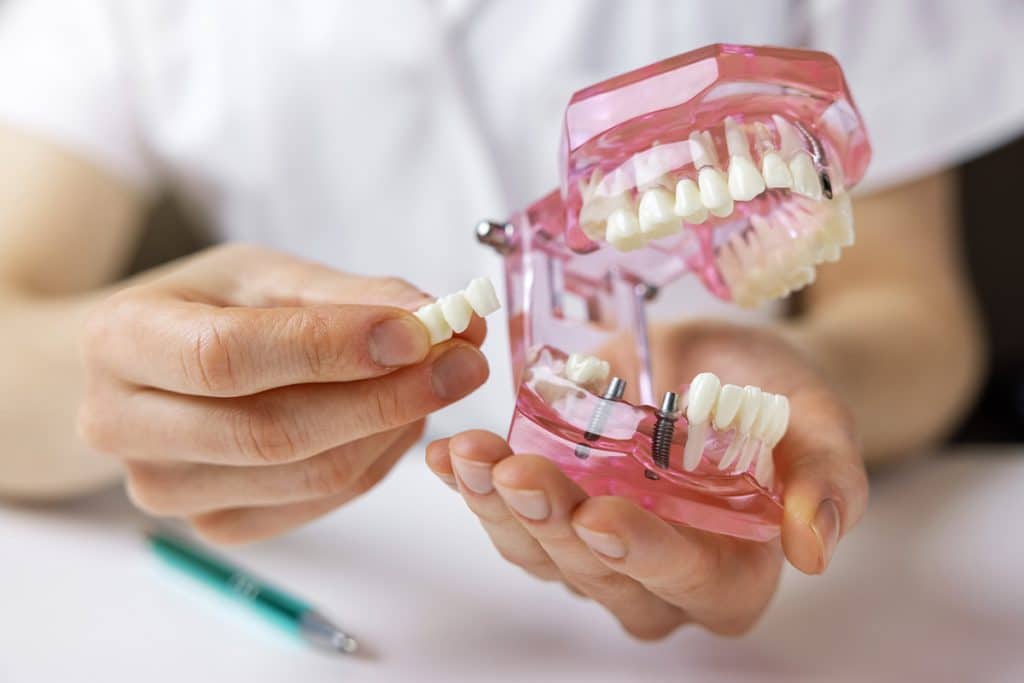 Dental Bridges vs. Implants: Which Option Is Right For You?