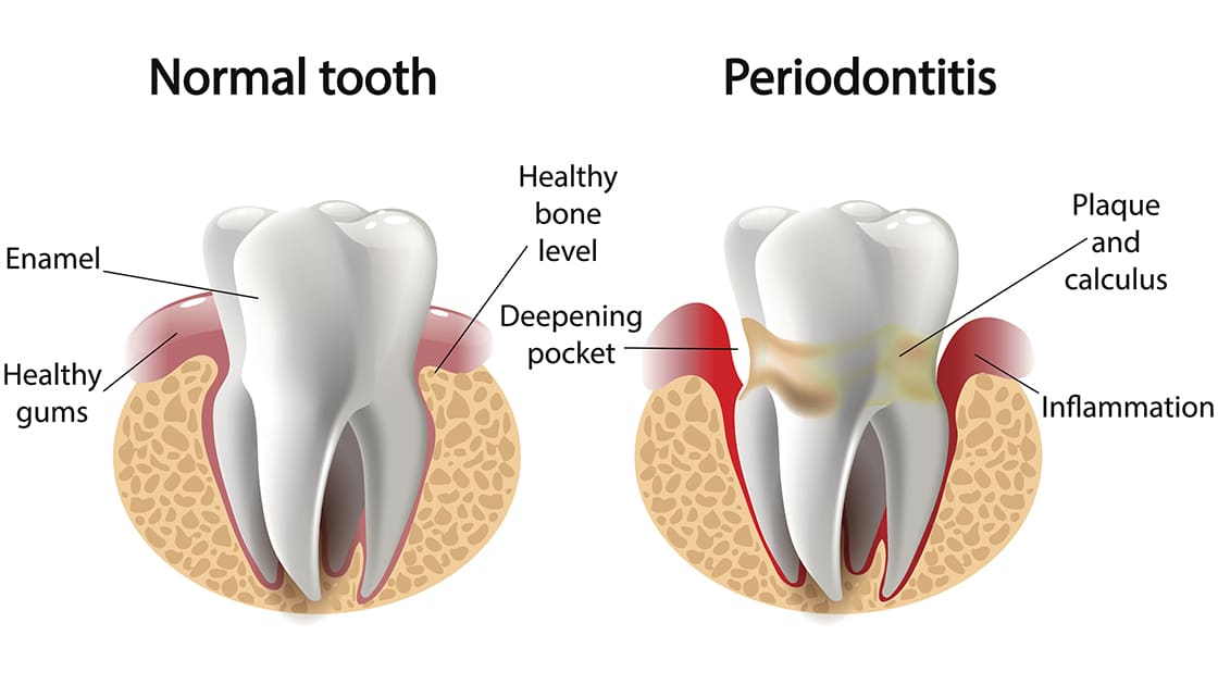 Healthy gums vs periodontitis graphic