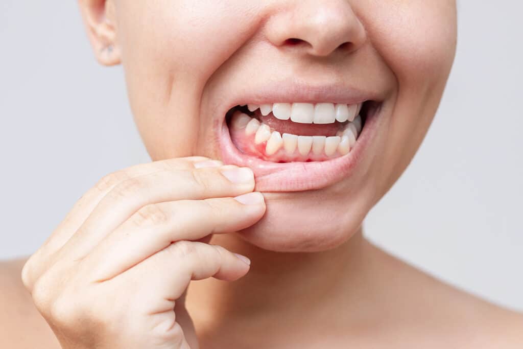 What Happens If You Leave Gum Disease Untreated?