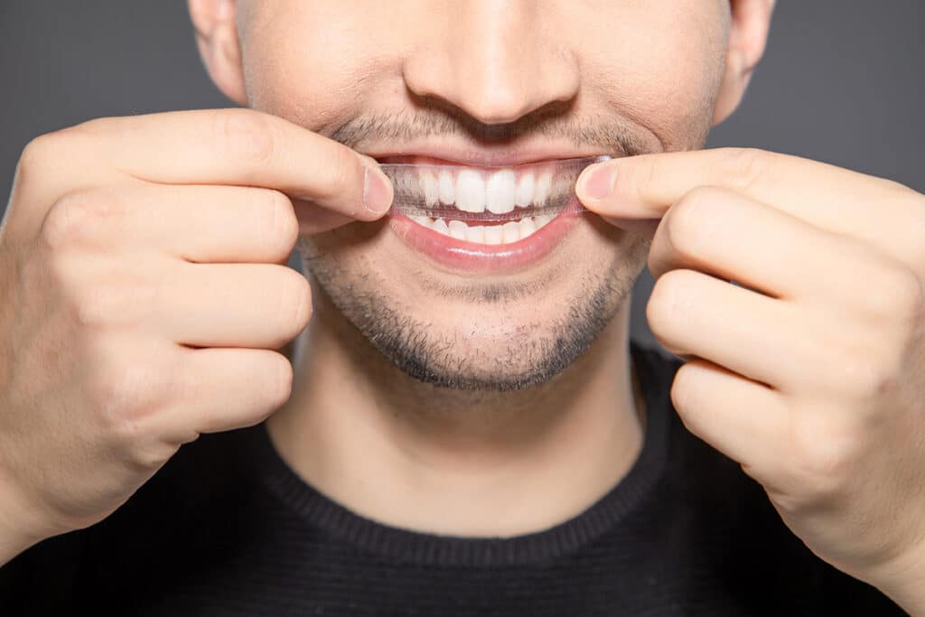 Whitening Strips vs. Professional Whitening: Which Gets Better Results?